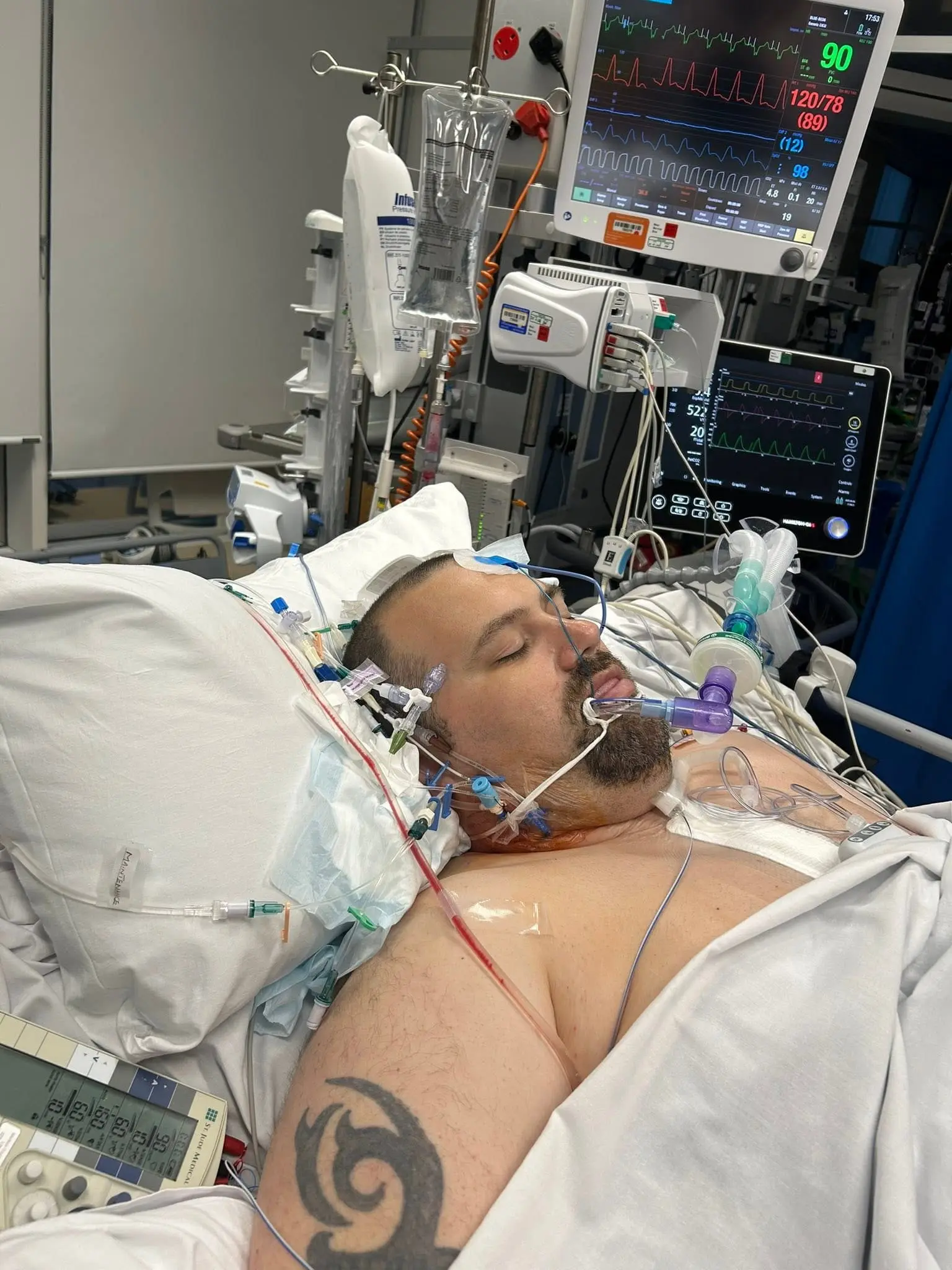 Mark in intensive care after open heart surgery
